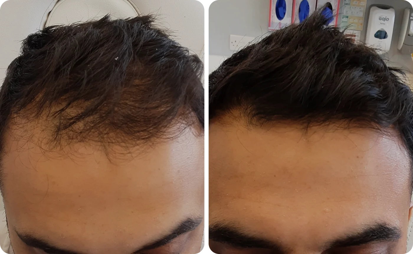 Iqbal, 39: hairline coverage before and after comparison