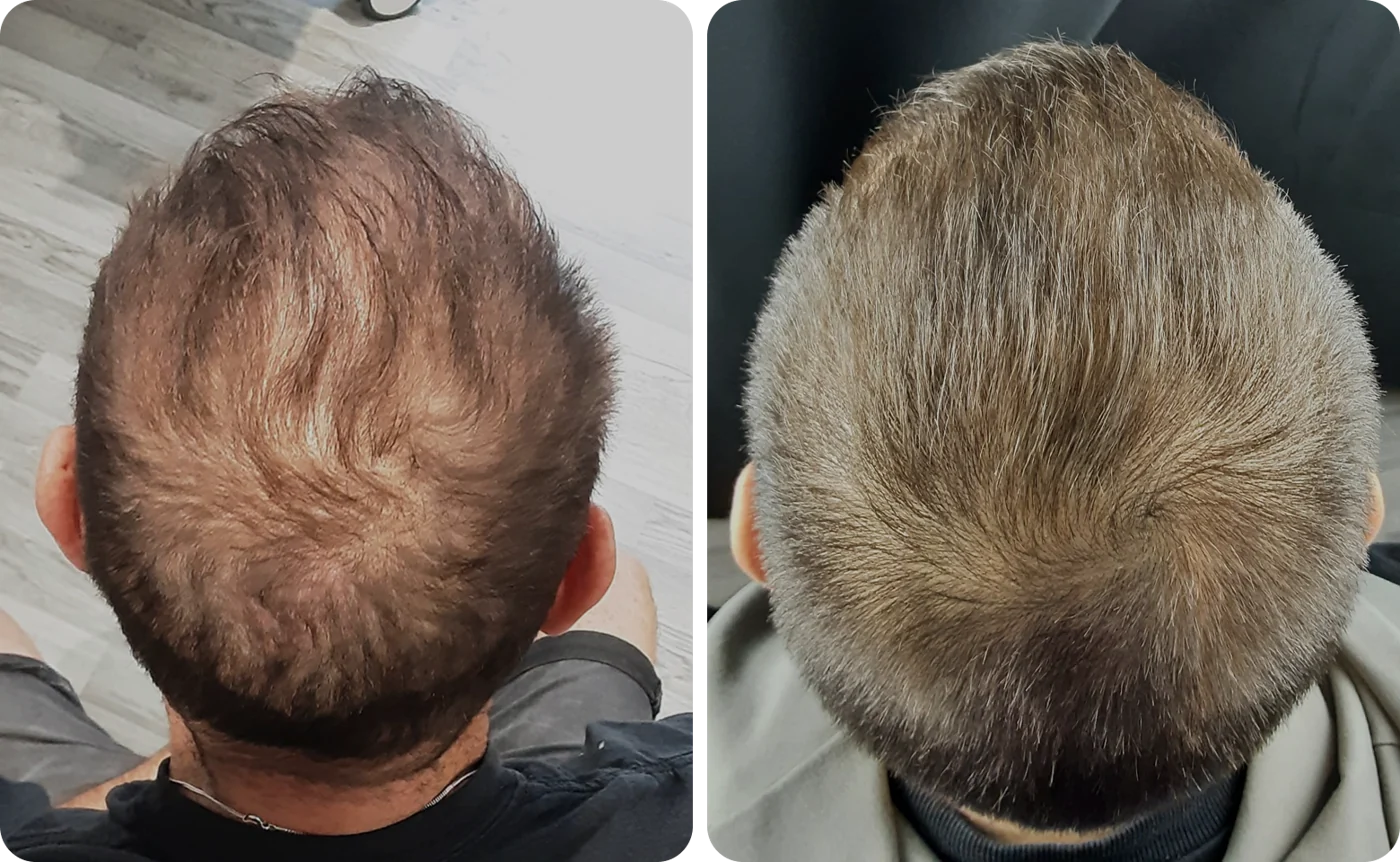 Member result 02: crown coverage before and after comparison