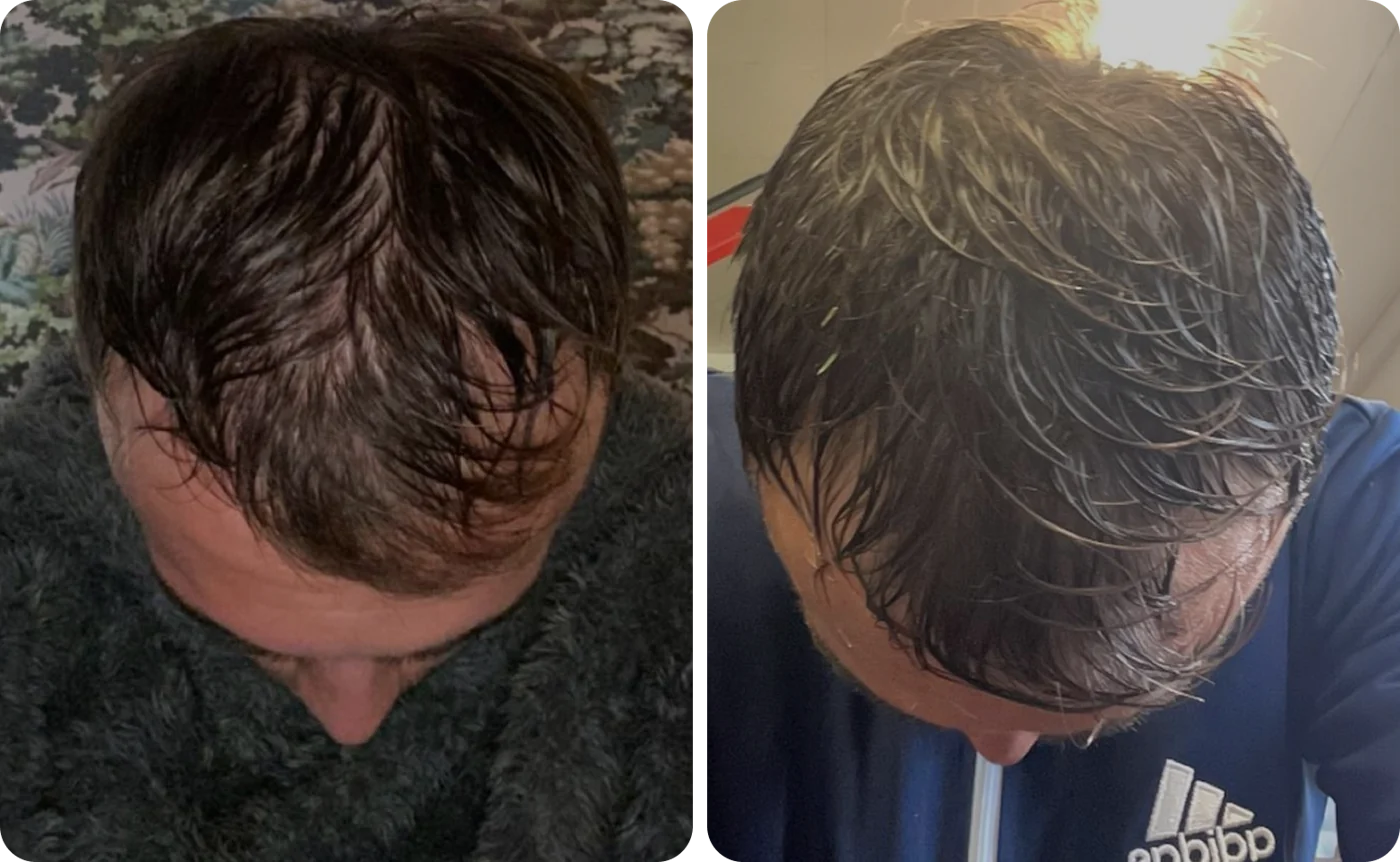 Member result 03: frontal hair coverage before and after comparison