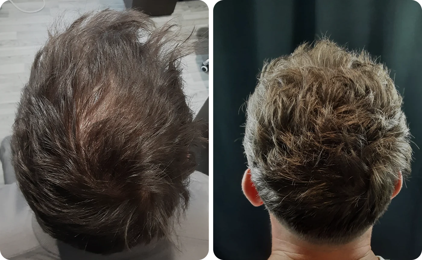 Member result 04: top and crown coverage before and after comparison