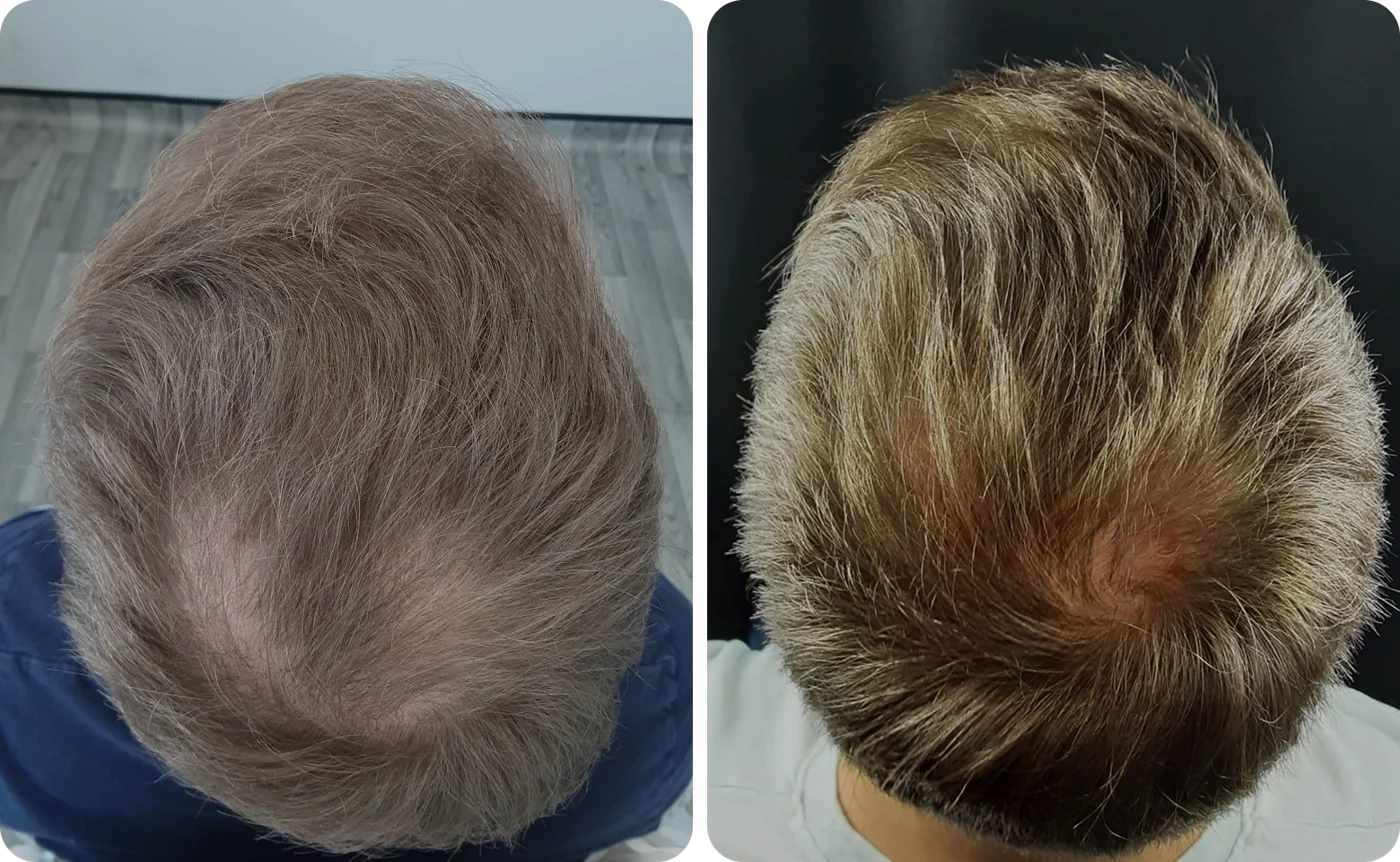 Member result 05: crown and mid-scalp coverage before and after comparison
