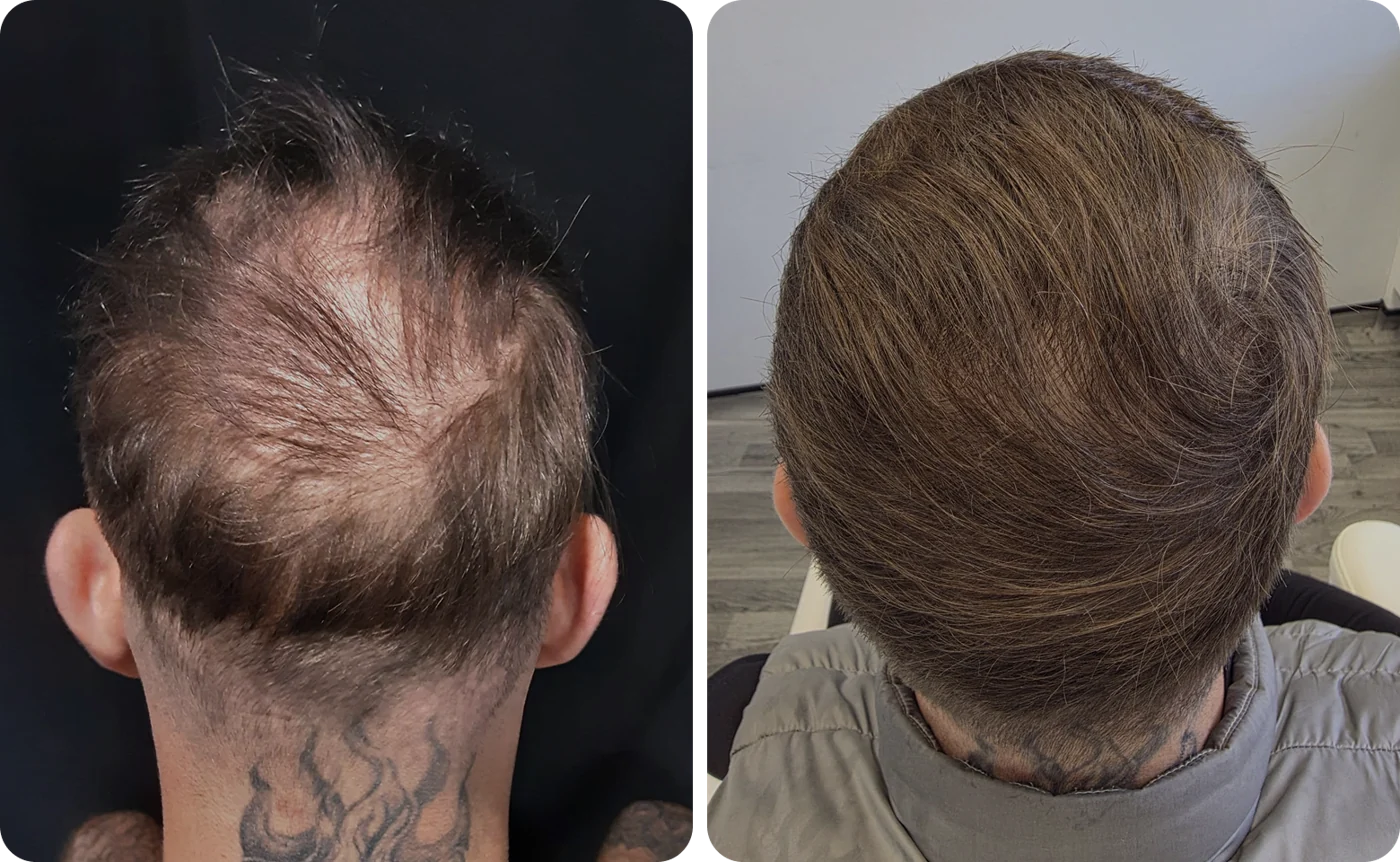 Member result 06: crown coverage from behind before and after comparison