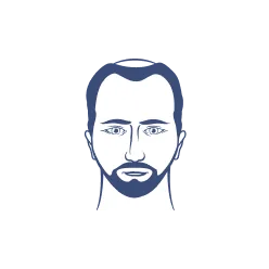 Thinning crown: a common sign of male hair loss