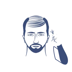 Excessive shedding: a common sign of male hair loss